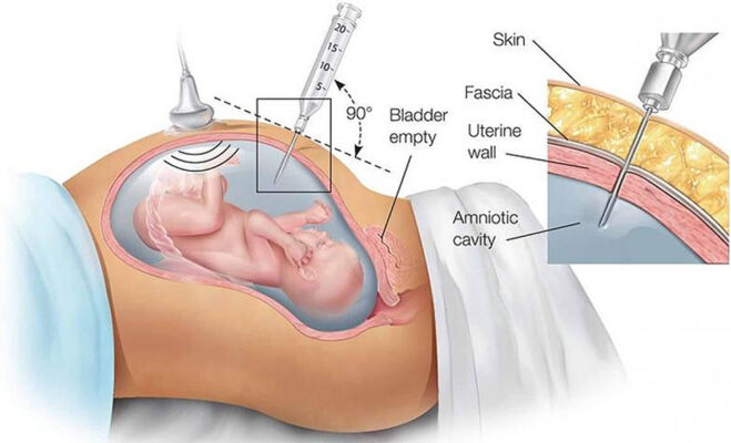 amniocentesis results